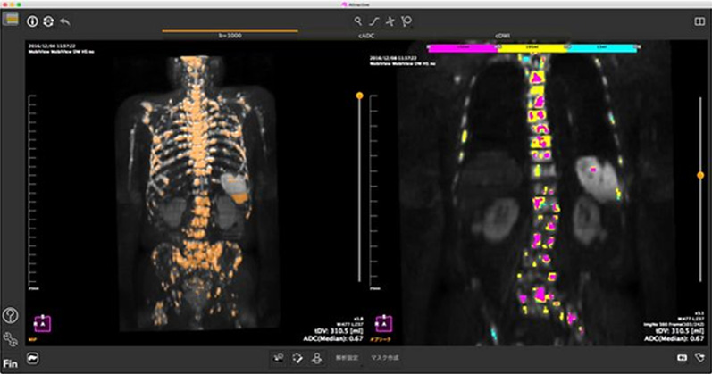 DWIBS：腫瘍検索を目的とした拡散強調MRIを利用した腫瘍体積測定アプリケーション